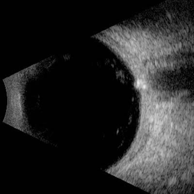 Ultrasonido ocular